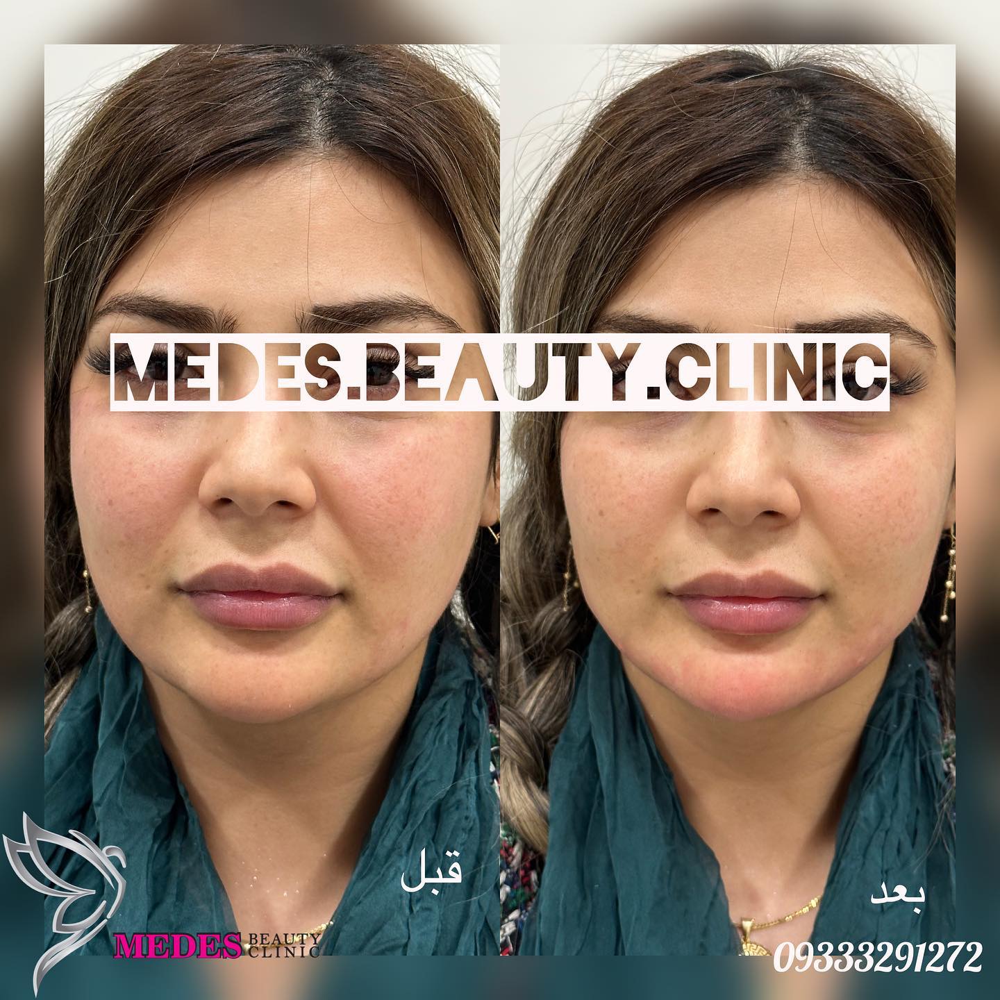 گالری زاویه سازی صورت